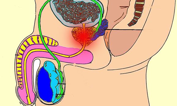 Воспаление простаты