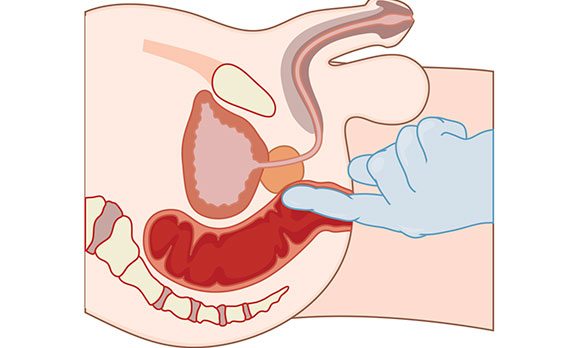 Массаж простаты пальцем