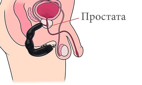 Прибор для лечения простатита