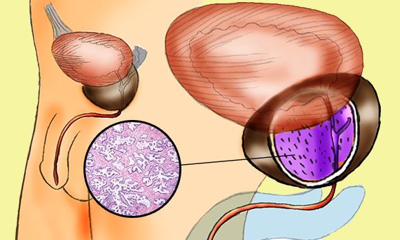 Гиперплазия простаты