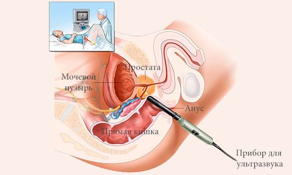 Проведение ТРУЗИ простаты