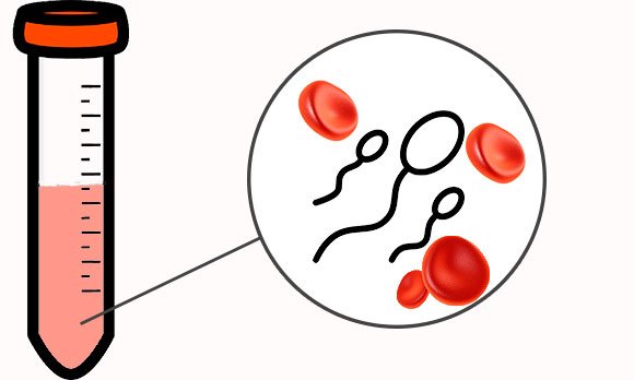 Кровь в сперме