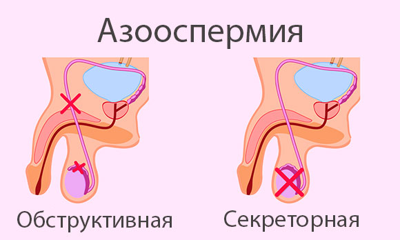 Виды азооспермии