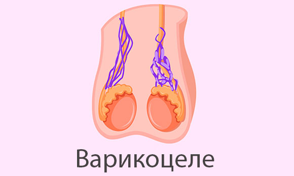 Варикоцеле