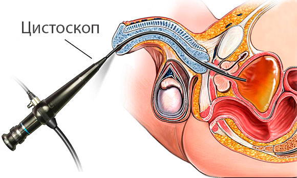 Цистоскопия уретрального канала