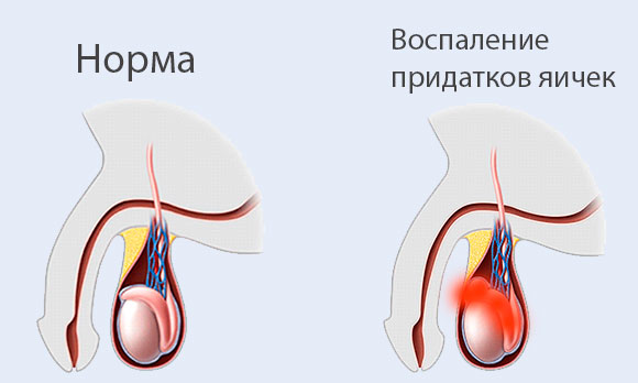 Воспаления придатков яичек