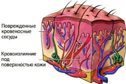 Каковы причины появления шишки на копчике у мужчины?