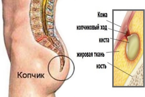 Киста копчика (эпителиальный копчиковый ход)