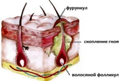 Каковы причины появления шишки на копчике у мужчины?