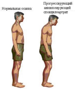 Почему болит копчик у мужчины?