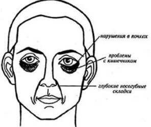 Почему наблюдаются мешки под глазами у мужчины?