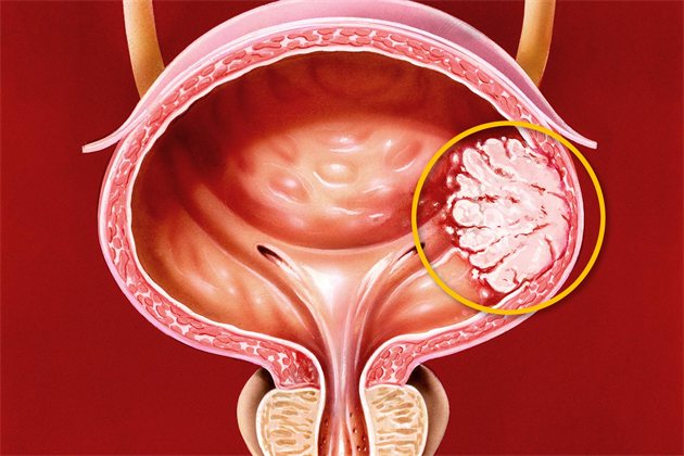 Как диагностируется рак мочевого пузыря