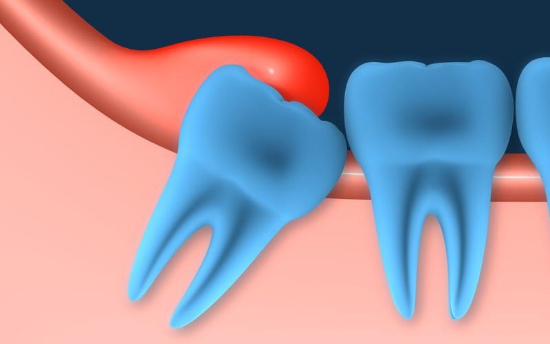 Зубы мудрости: удалять или оставить?