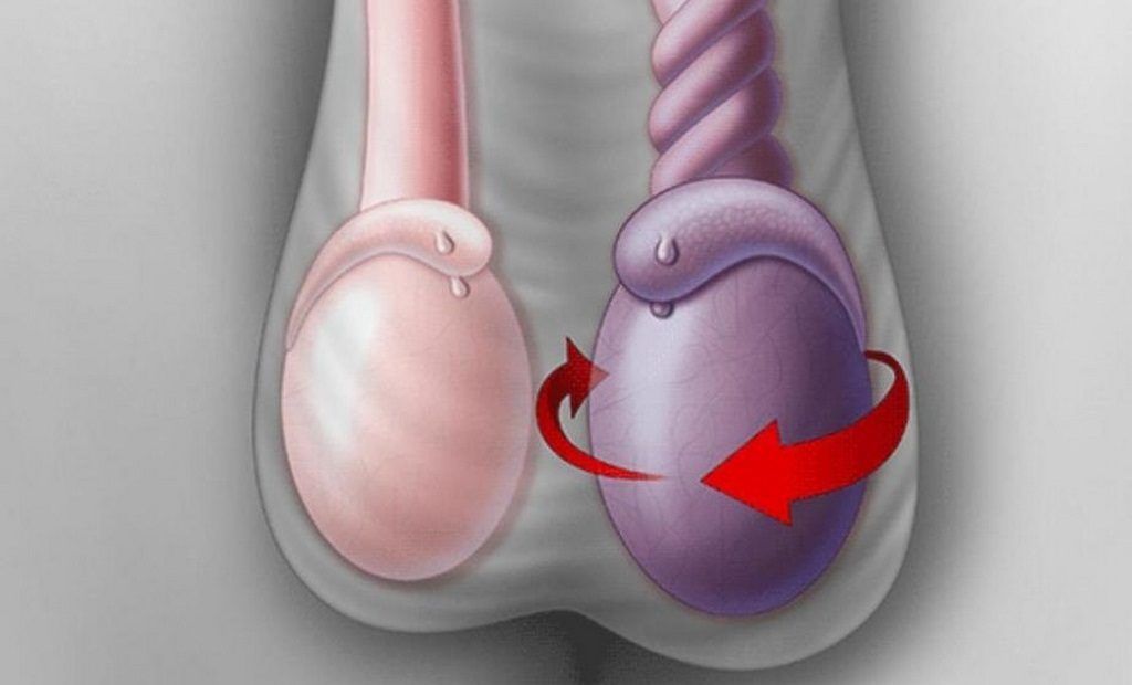 Чем опасен перекрут яичка у мужчин