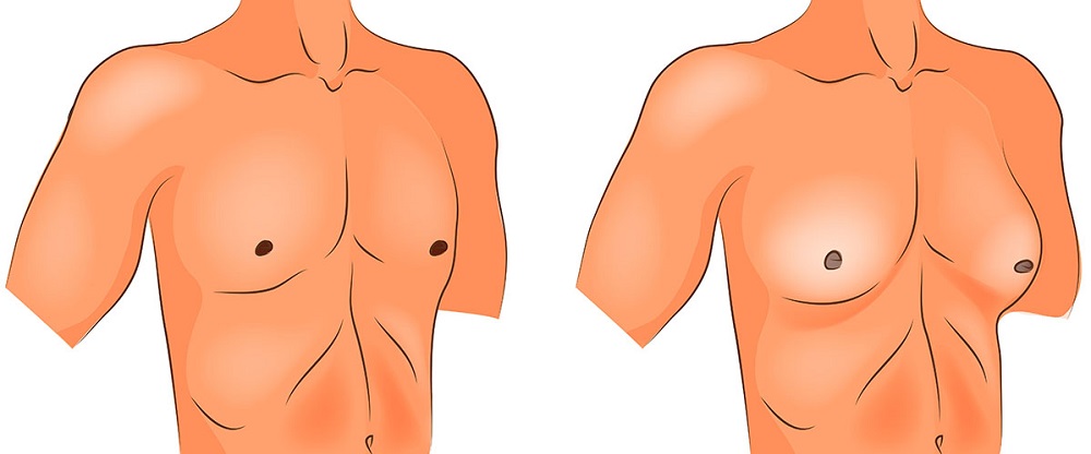 Гинекомастия у мужчин: причины и методы лечения