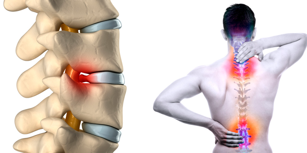Как вылечить грыжу на позвоночнике без операции