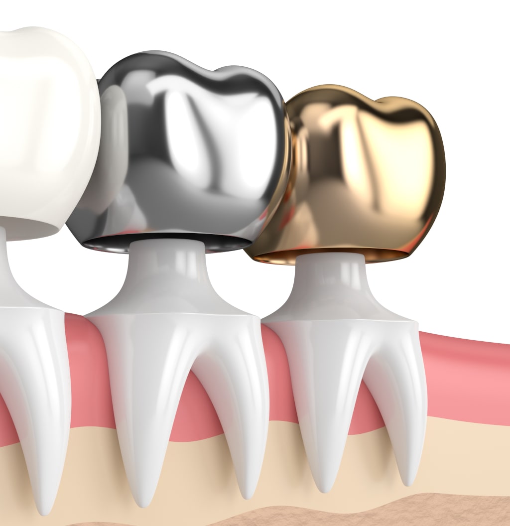 Какие бывают коронки для зубов