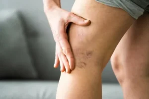 Varicose veins or just dilated veins, how to understand?