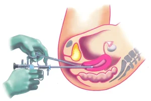 Гистероскопия матки: что это такое и в каких случаях необходима